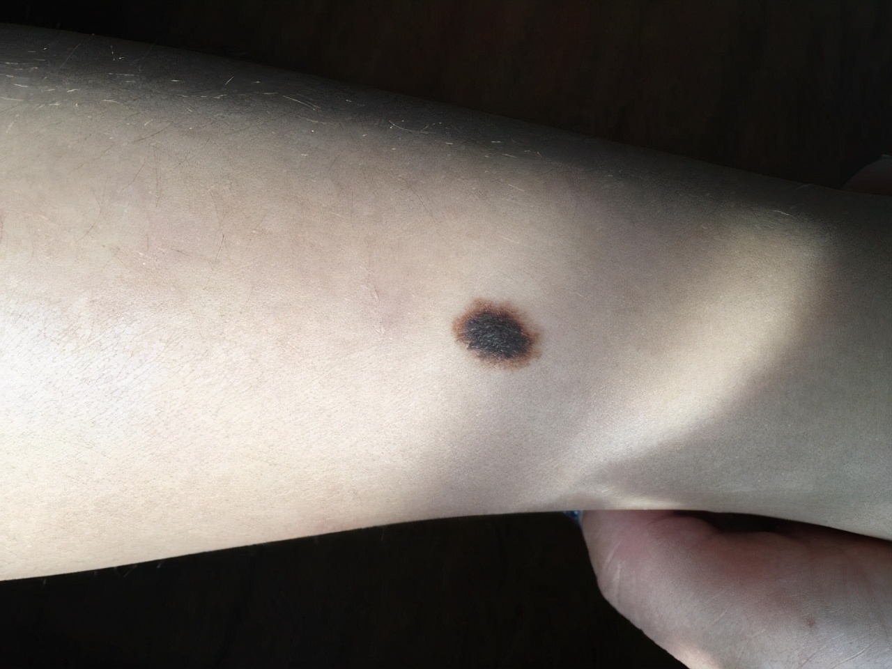 宝宝背后有痣代表什么,宝宝身上的痣会随着身体长吗