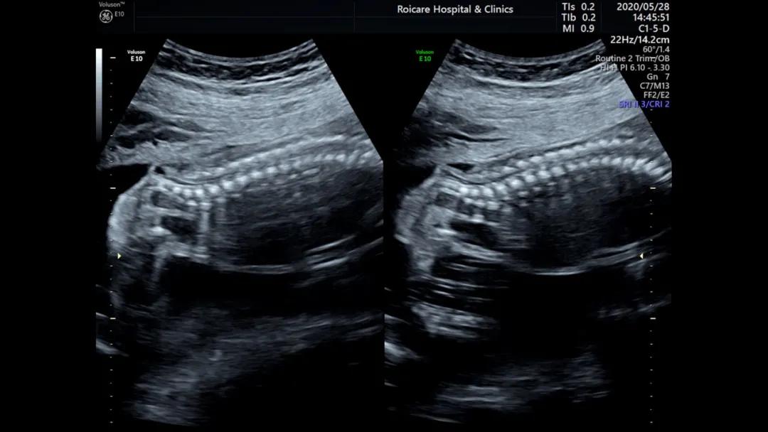 胎儿脊髓圆锥位置低是什么情况,胎儿脊髓圆锥位置偏低做核磁共振