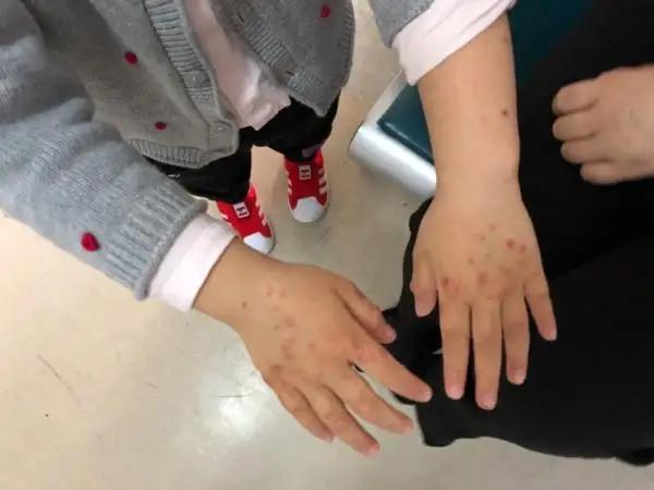 湿疹去免疫科,湿疹长水泡可以擦护手霜吗