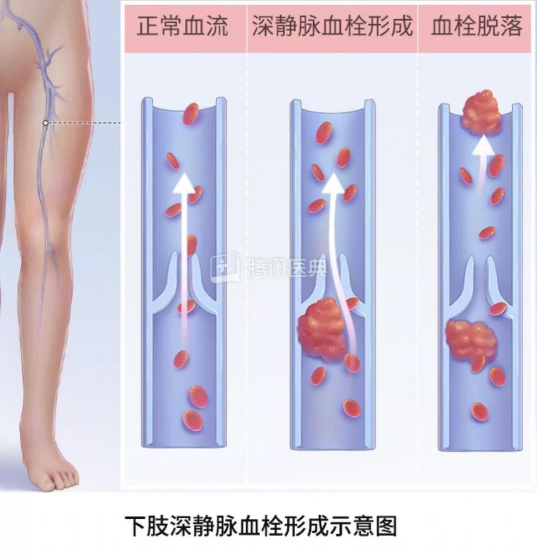 深静脉血栓的治疗方法,什么是下肢深动脉血栓