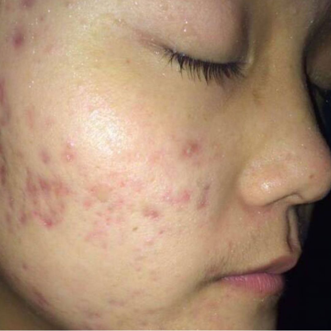 祛痘印的方法怎么可以快速祛痘印,怎样有效快速祛痘祛痘印