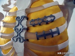 开胸手术断的肋骨怎么办,肋骨断了手术需要多少钱在上海