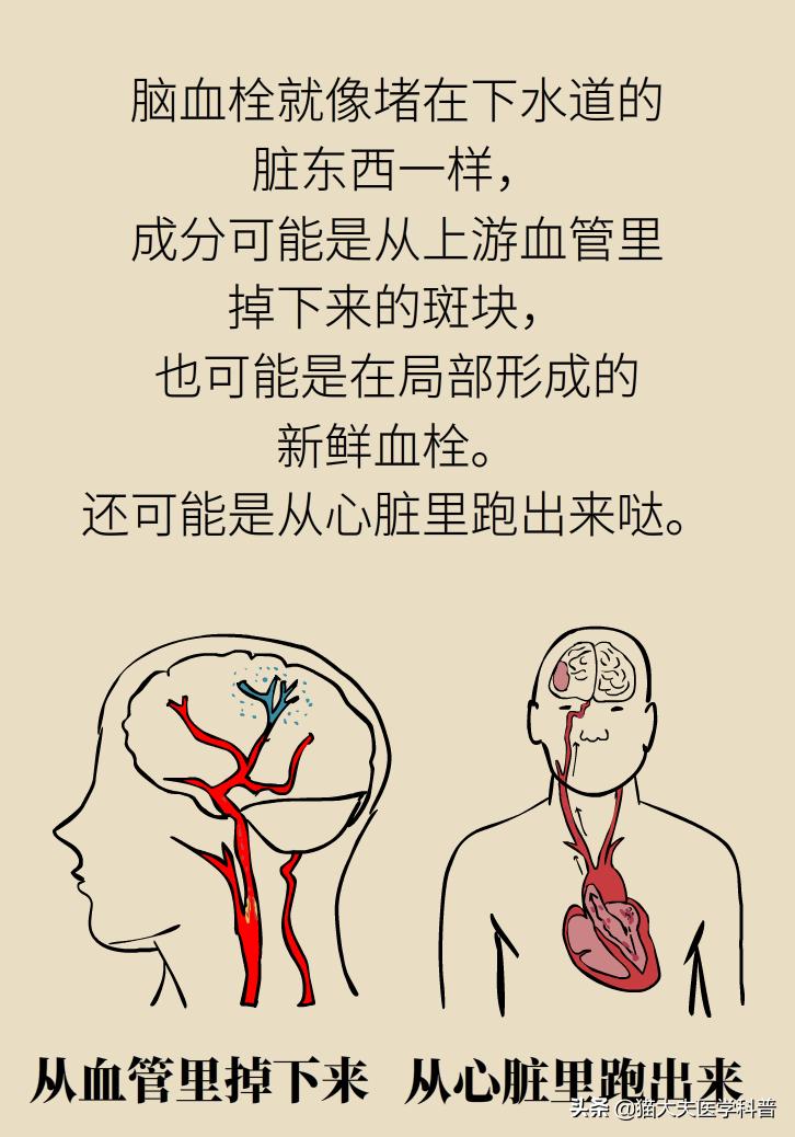 不手术能彻底治好血栓外痔吗,介入治血栓最好的方法