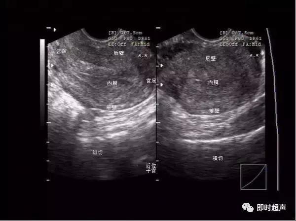 妇科阴式超声检查方法,盆底超声可检查什么疾病