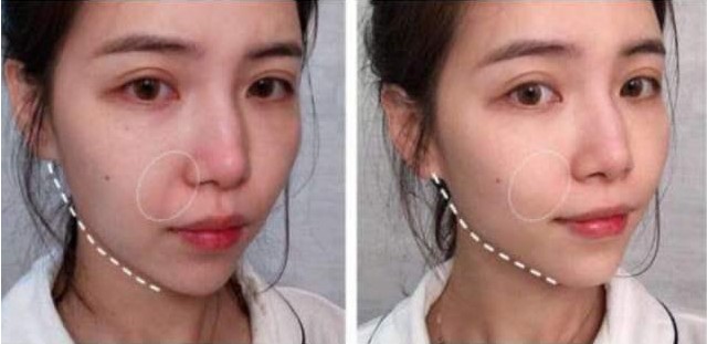 美容针美容的误区,为美而整容最后付出的代价