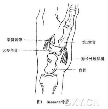 几种严重骨折医学名称,常见的骨折有哪些名称