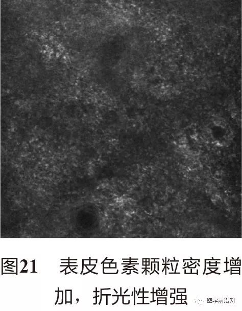 皮肤共聚焦显微镜能查什么,皮肤镜和共聚焦显微镜