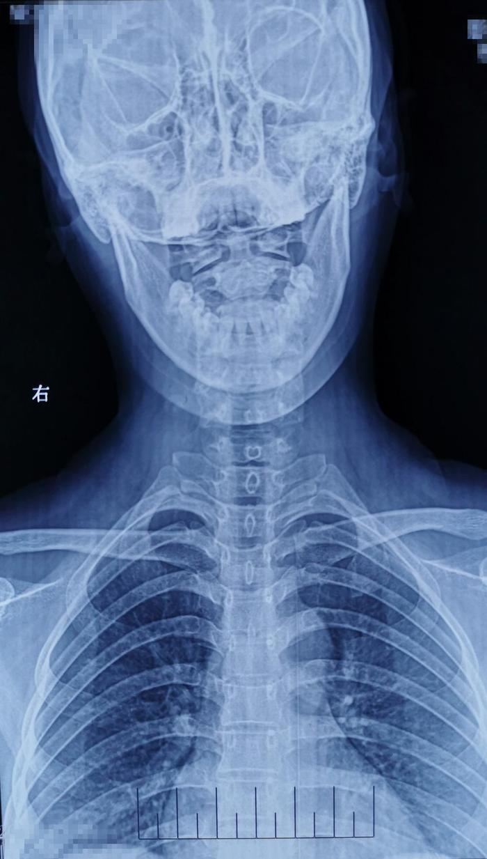 因颈背部疼痛、上臂抽疼,检查出颈5椎体结核