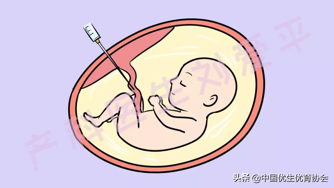 羊水穿刺孕妈,做羊水穿刺之后孕妈呼吸急促