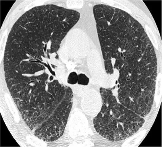 间质性肺疾病看病经验分享,分享肺腺癌临床实验的例子