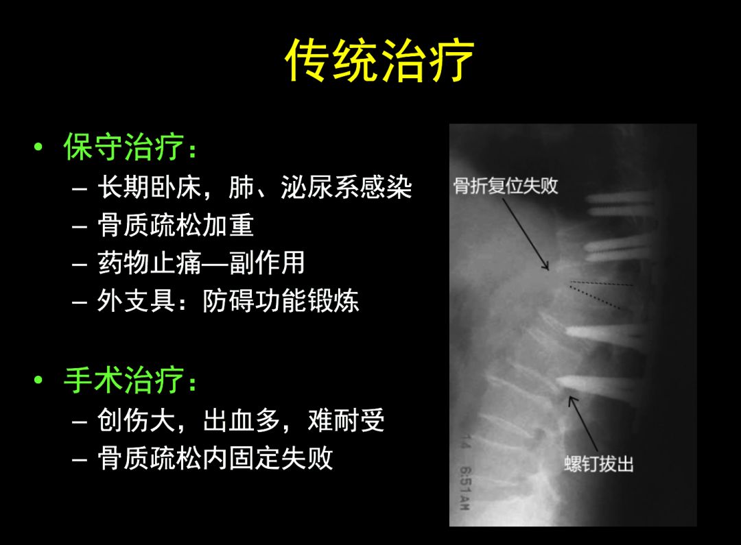 腰椎压缩骨折椎体成形术啥时候做,骨质疏松骨折椎体成形术操作步骤