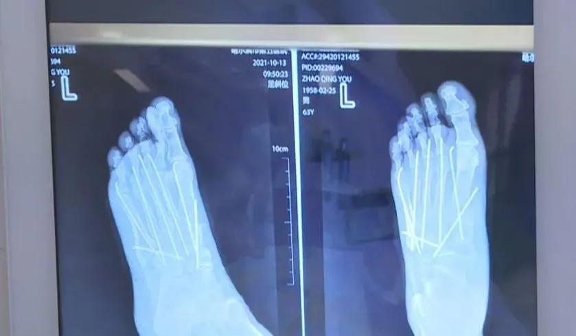 46岁男子双腿被砸成重伤,哈尔滨一男子被砖头砸