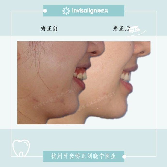 杭州牙齿矫正丨露龈笑怎么办？全面告别露龈笑的4大方法