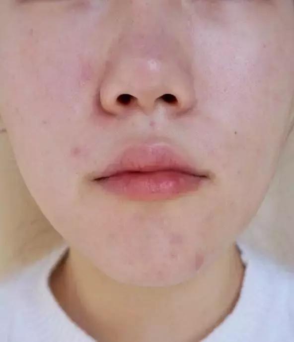 痘印根本治不住怎么办,痘印反反复复消不掉