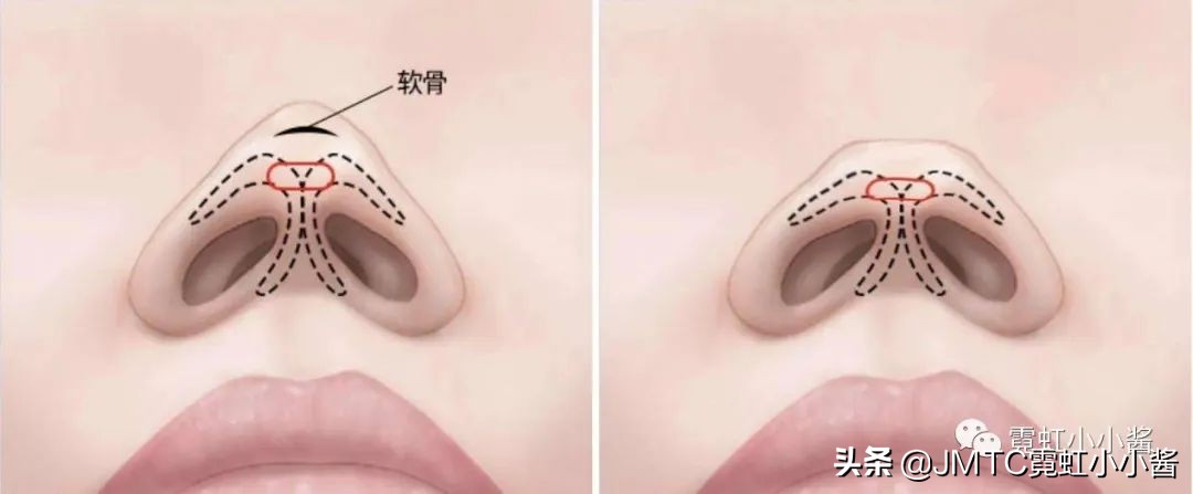 鼻子怎么修复好看呢,鼻型修复方法大全