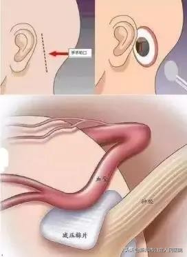 儿童面肌痉挛会频繁眨眼吗,面肌痉挛眨眼耳朵响怎么治疗