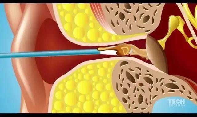 用棉签掏耳朵的危害动画,用棉签掏耳朵对身体有害吗