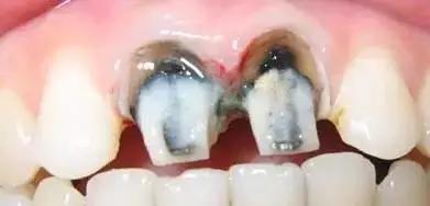 烤瓷牙套里的牙烂了有什么症状,烤瓷牙牙套里的牙烂了怎么处理