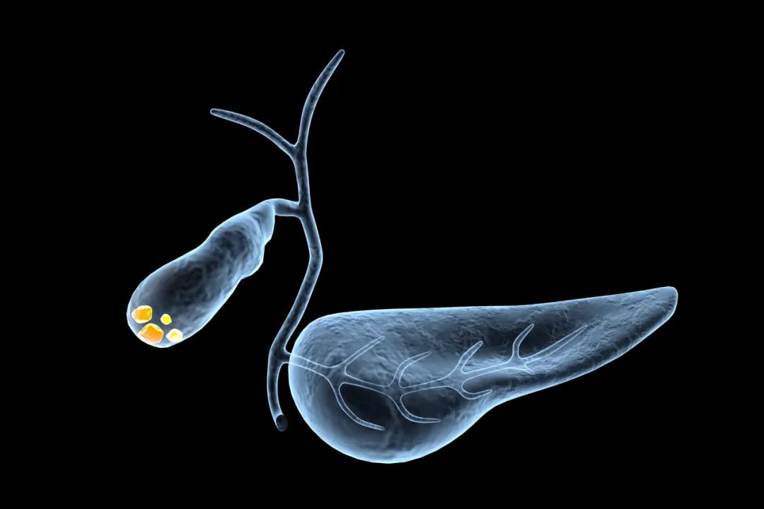 谨防结石,胆结石最怕这几个习惯