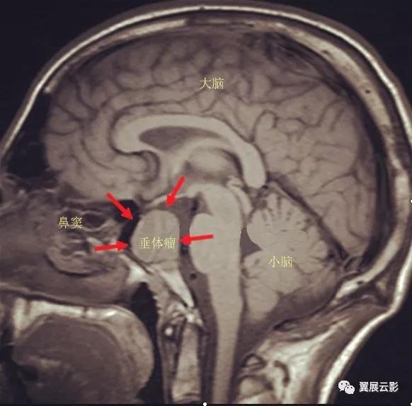 脑部脓肿怎么治疗,多发性脑脓肿能自愈吗