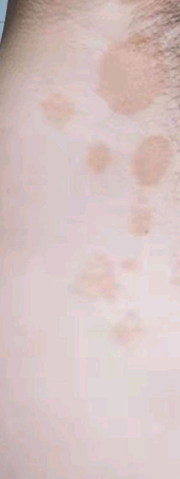 小儿如何才能根治汗斑足癣,汗斑怎么去除才能彻底根治