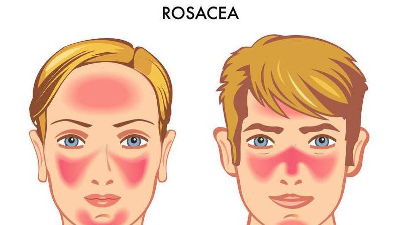 玫瑰糠疹一热就发红影响恢复吗,玫瑰痤疮红肿痒怎么办