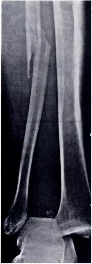几种严重骨折医学名称,常见的骨折有哪些名称