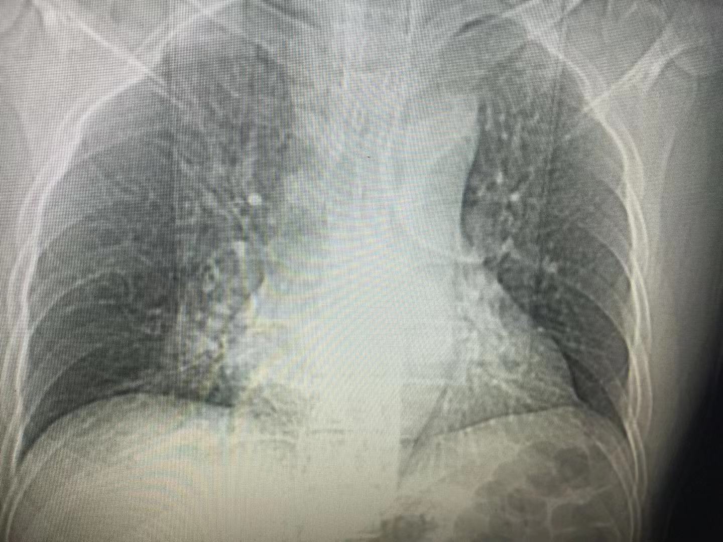 只是咳嗽要去医院做什么检查,感冒咳嗽需要拍胸片吗