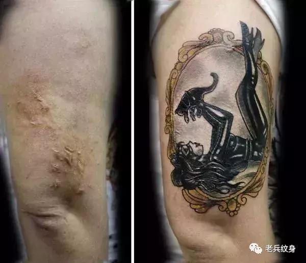 疤痕体质可以用纹身去遮盖疤痕吗,你的疤痕是什么颜色呢