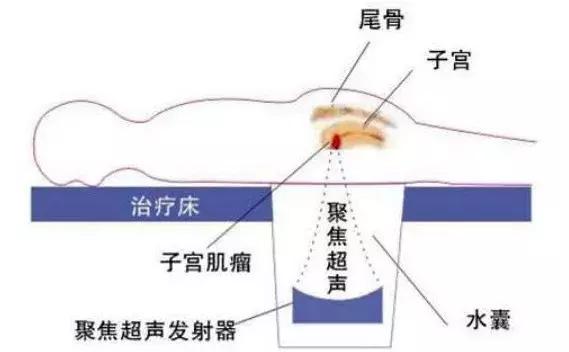 赞！不开刀不流血就把手术做了，赤峰市肿瘤医院迈入微无创时代