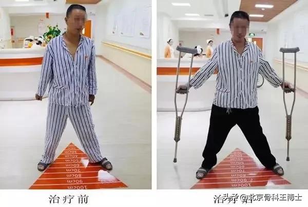 股骨头坏死,股骨头坏死前期锻炼能自愈吗