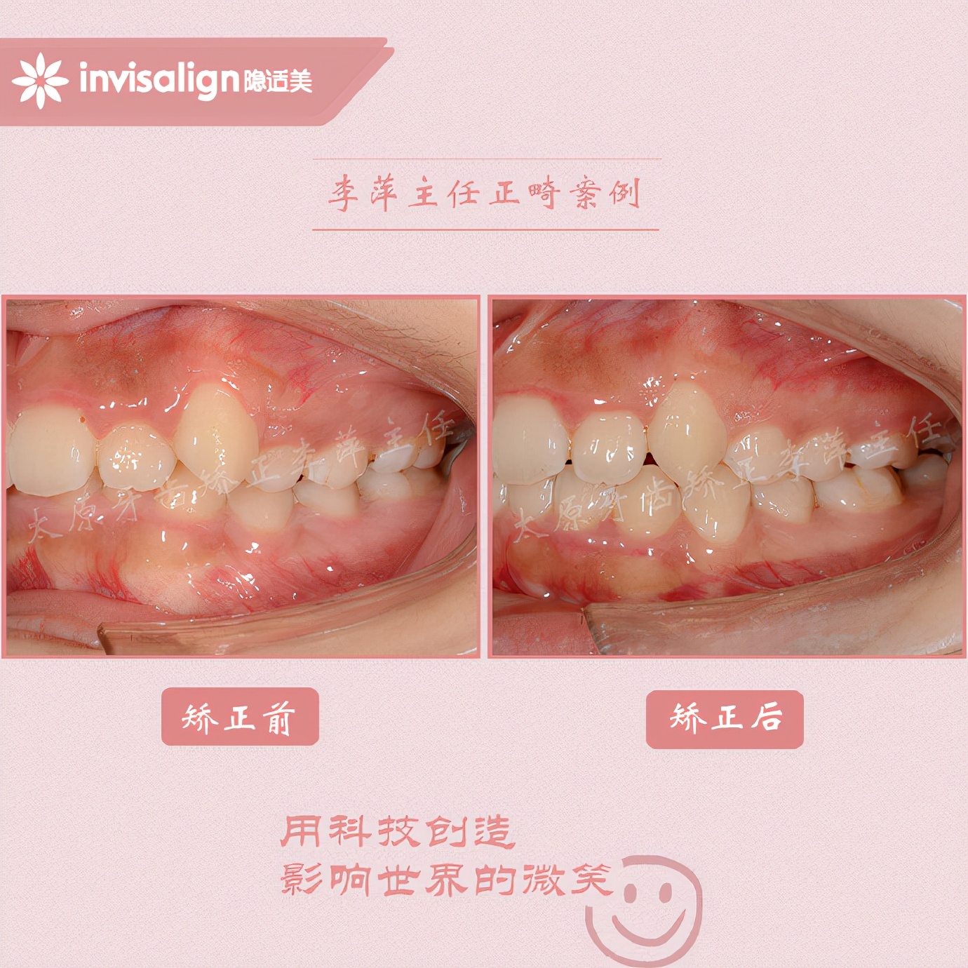 太原牙齿隐形矫正,太原牙齿正畸贵吗
