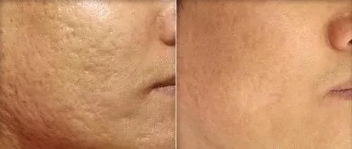 疱疹后遗症怎么治,疮疤留下的黑印怎么消除