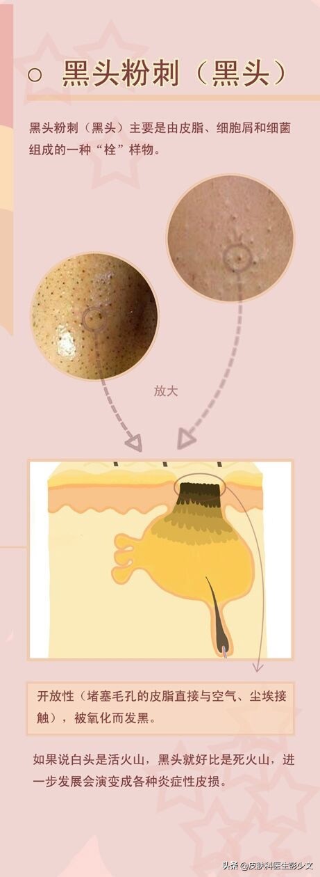 痘疮怎么治疗最快啊,身体长痘长疮怎么办最快消除