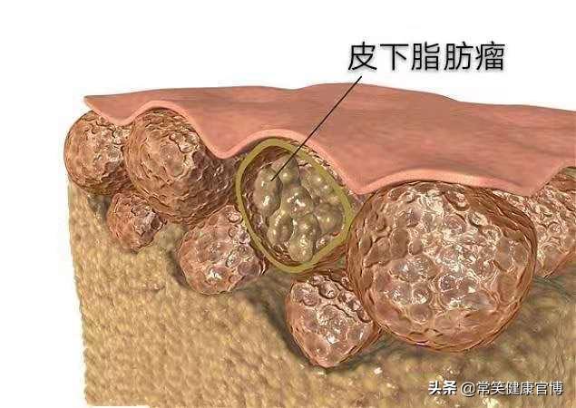 全身皮下能摸到小疙瘩,身上皮下摸到小疙瘩