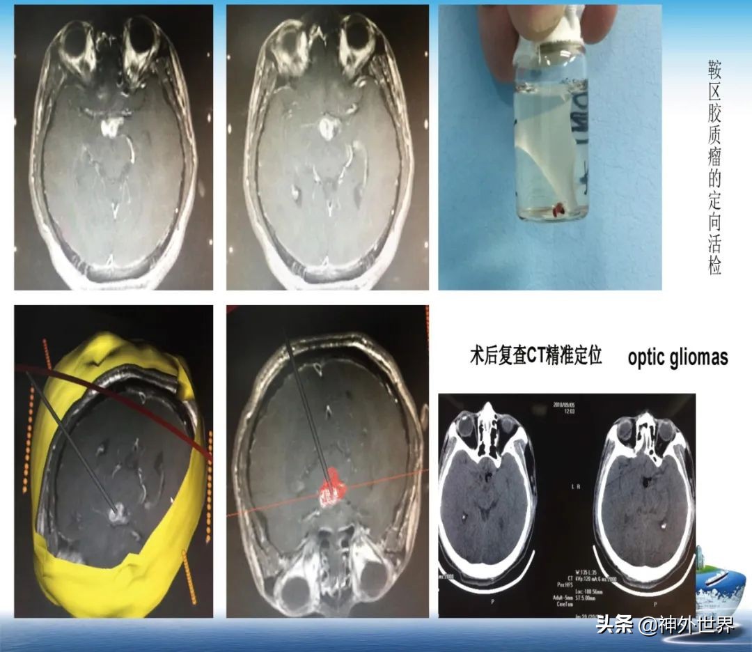 宣武医院神经外科王亚明祖籍,北京宣武医院神经科专家王亚明