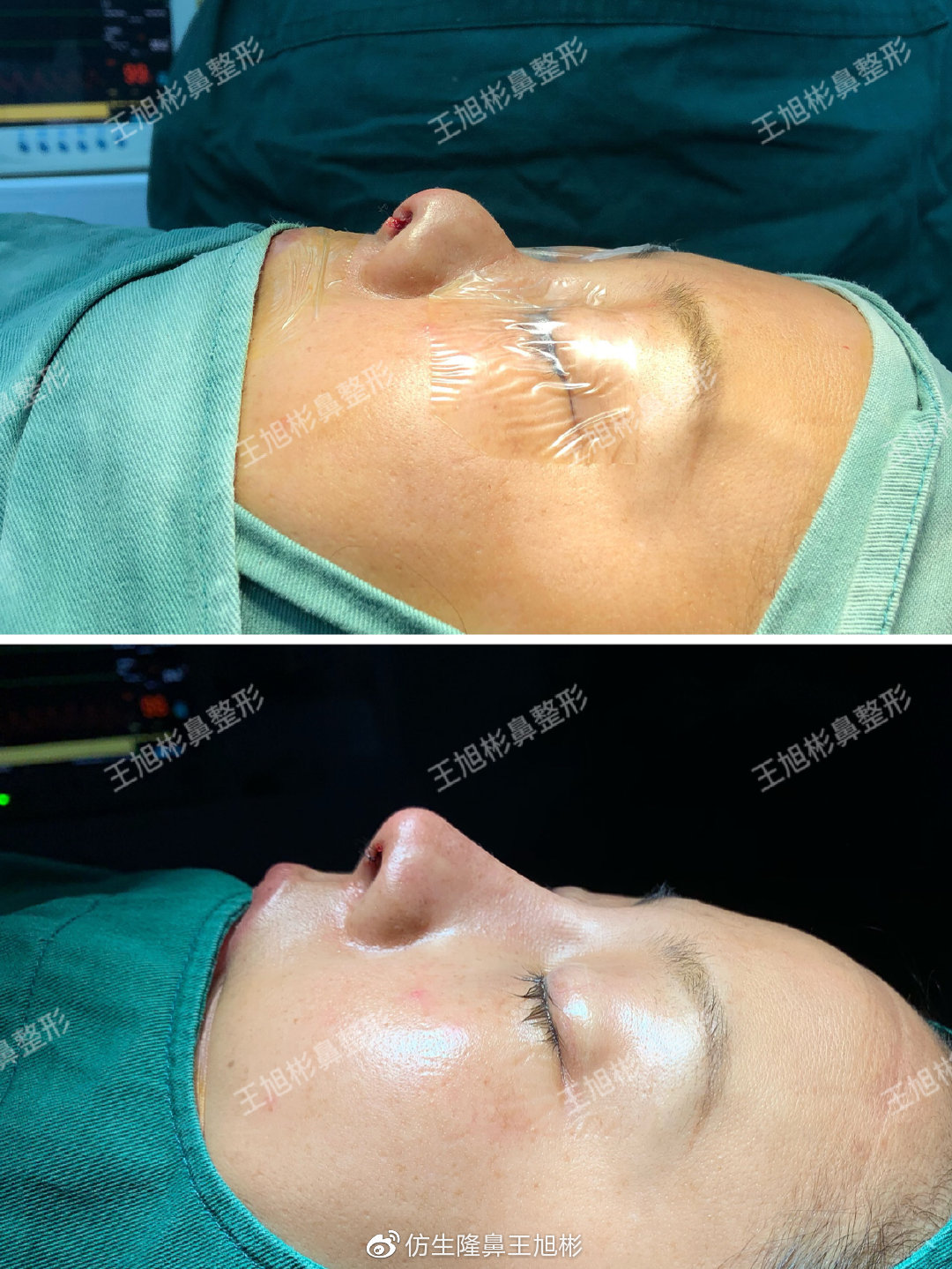 短鼻整形手术,鼻整形短鼻