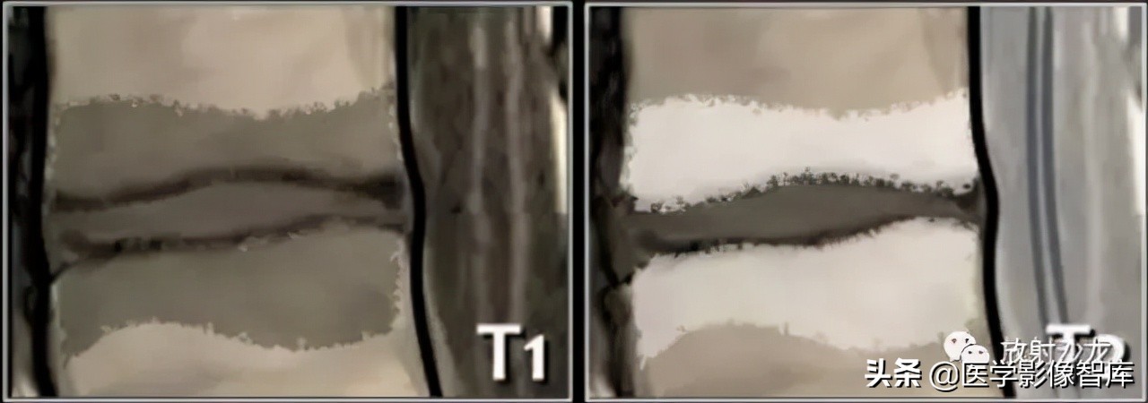 一键收藏所有的内容,颈椎间盘病变的症状和治疗