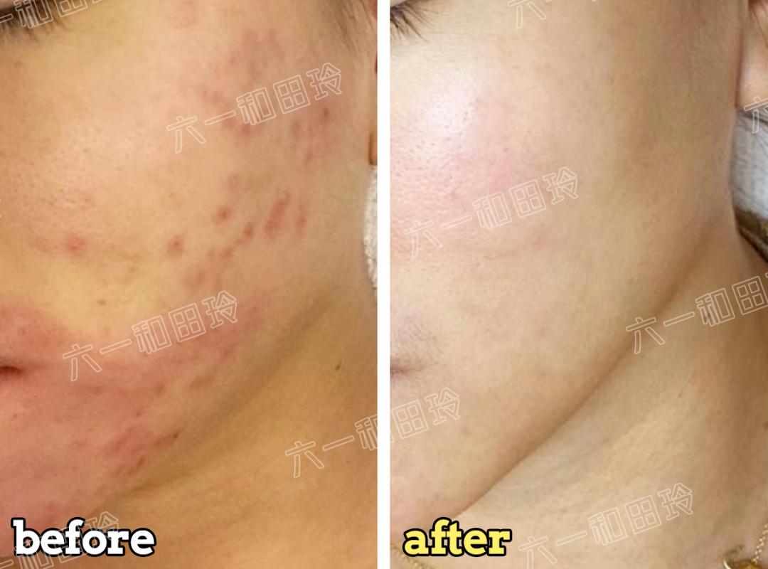 医美刷酸后爆痘期要多久,痘痘肌医美刷酸能好吗