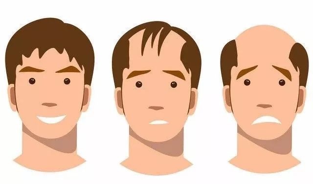 脂溢性脱发能治好吗知乎,脂溢性脱发能治好吗怎么治疗