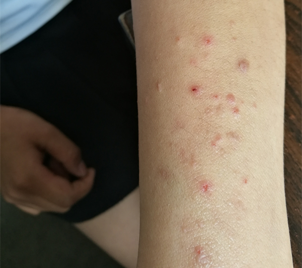 光过敏/多形性日光疹