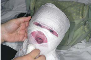 湿疹皮炎怎么治疗才能好,湿疹皮炎的最佳治疗方法