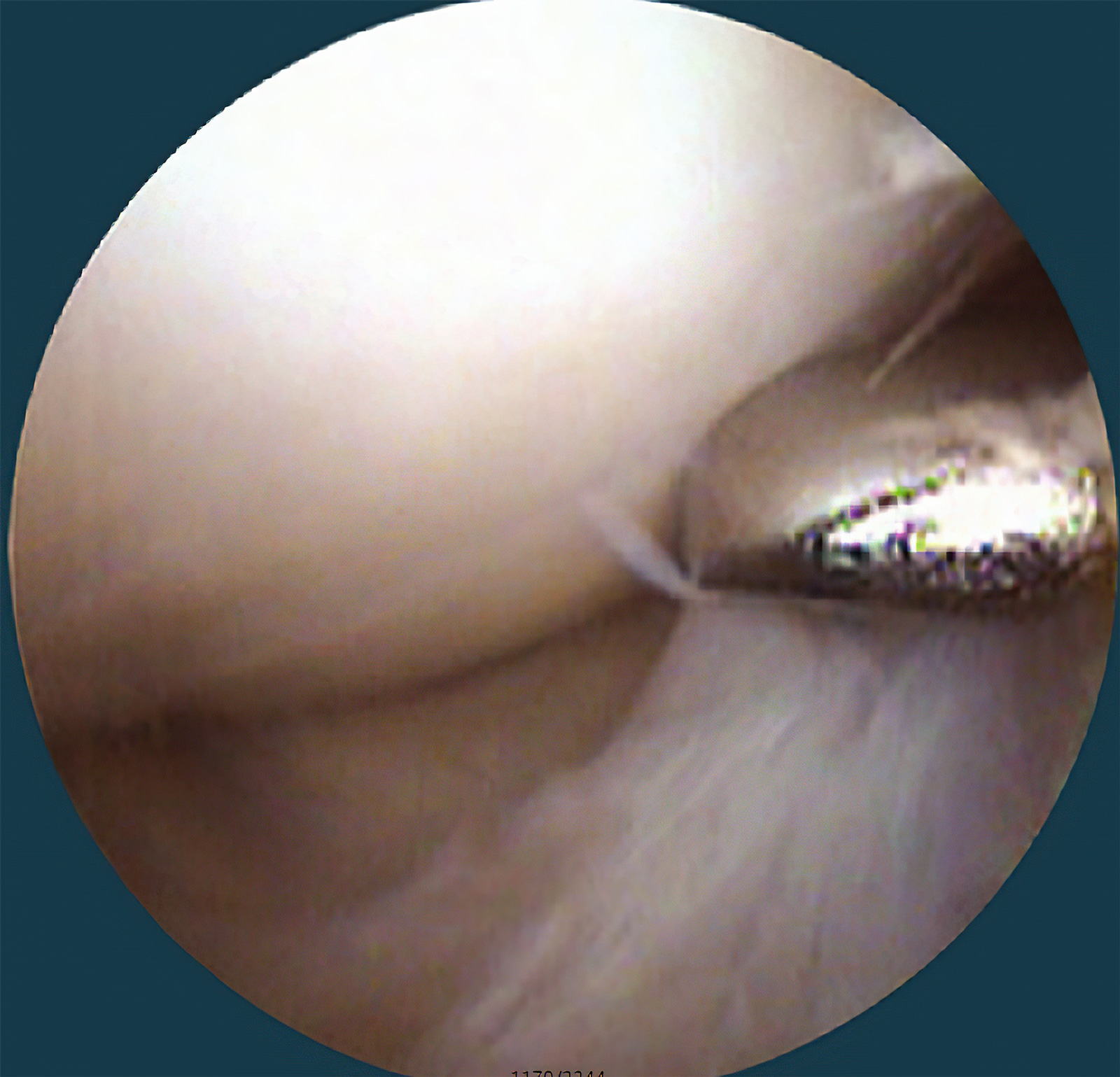 膝关节骨关节炎怎样手术能治好,膝关节镜能治好关节炎吗