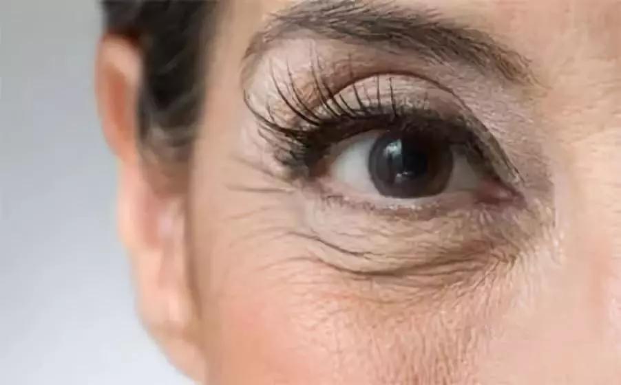 脂肪粒别用针挑教你一个土办法,脂肪粒怎么用针挑出来不疼