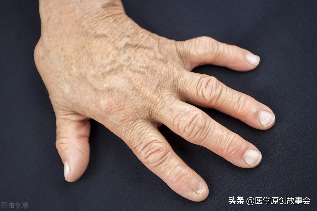 别把肺癌当成骨质增生,肺癌晚期骨质增生