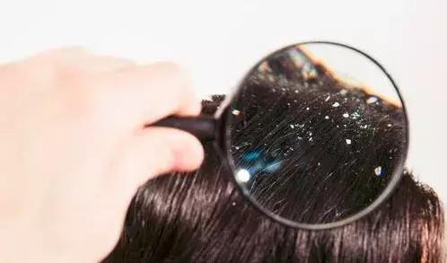 头皮油头皮痒头皮屑多,头皮油头皮屑多头发干枯