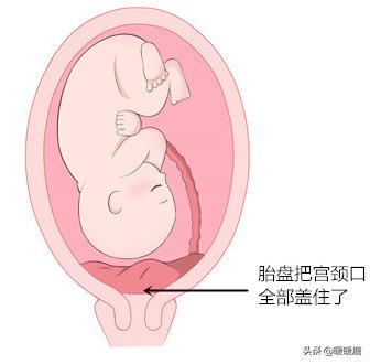 前壁胎盘和前置胎盘有什么区别,前壁胎盘和前置胎盘的区别有哪些