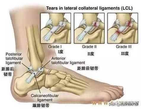 踝关节不稳的发生机制、康复训练及预防