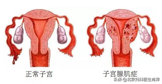 腺肌症北京哪个大夫能治疗,孙爱达医生腺肌症