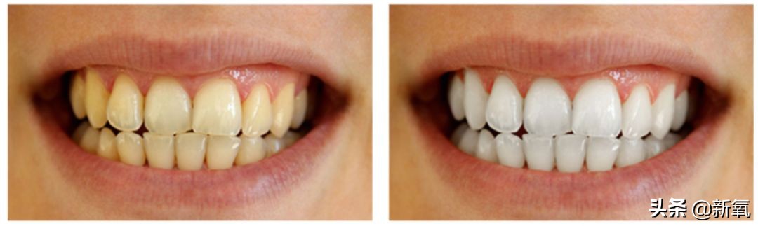 宋祖儿牙齿是烤瓷牙吗,宋祖儿牙齿